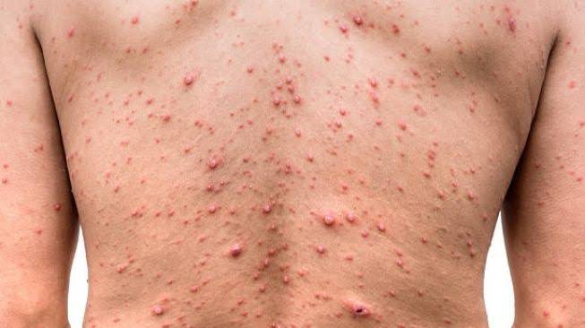 Kemenkes Aktifkan Sistem Surveilans Diseluruh Pintu Masuk Untuk Cegah Cacar Monyet