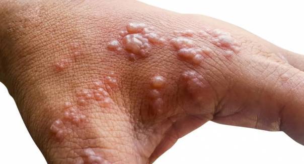 Dinkes Pekanbaru Himbau Masyarakat Waspadai Penyebaran Virus Cacar Monyet