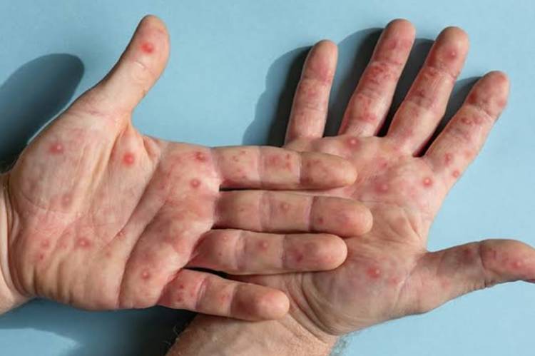 Cacar Monyet Belum Terdeteksi di Riau, Tetap Waspada