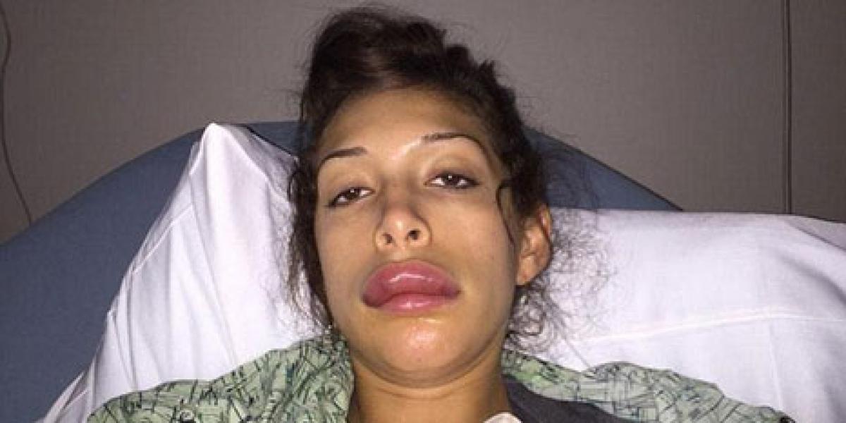 Bintang Porno Terlihat seperti Bebek Usai Suntik Bibir