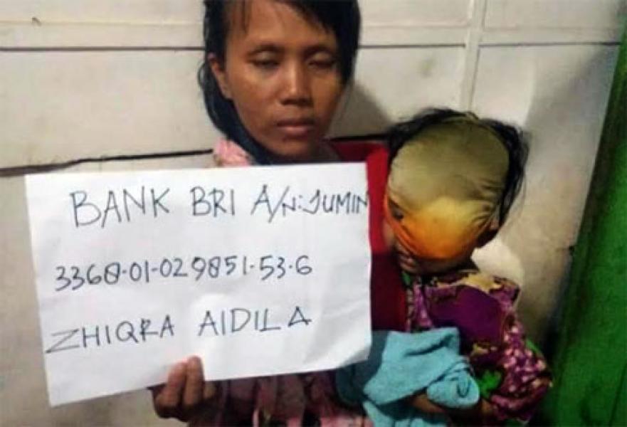 Terkait Balita Penderita Tumor Mata, Bupati Rohil Perintahkan Bantu Pengobatan 