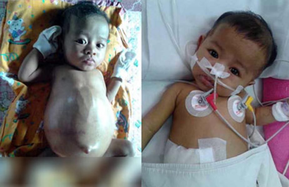 Suknia Clarisa Bayi 5 Bulan Penderita Hati Butuh Uluran Tangan Dermawan