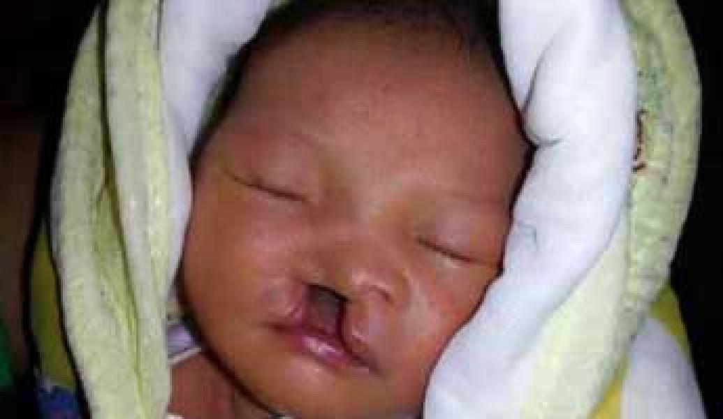 Bayi Bibir Sumbing Tanpa Langit Langit