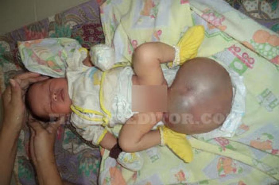 Belum Ada Rekom, Balita Penderita Tumor Terlantar di RSUD Arifin Achmad