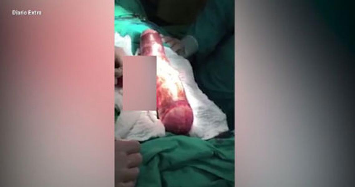 Singkong 45 cm Tersangkut di Anus, Pria Ini Jalani Operasi