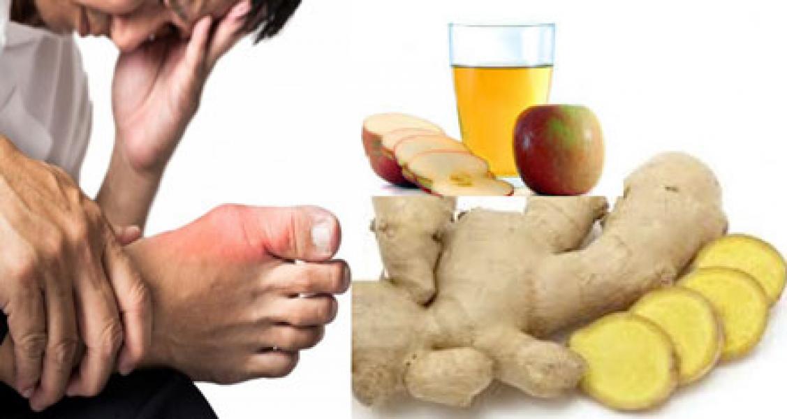 Terkena Asam Urat? Coba Obat Alami Ini