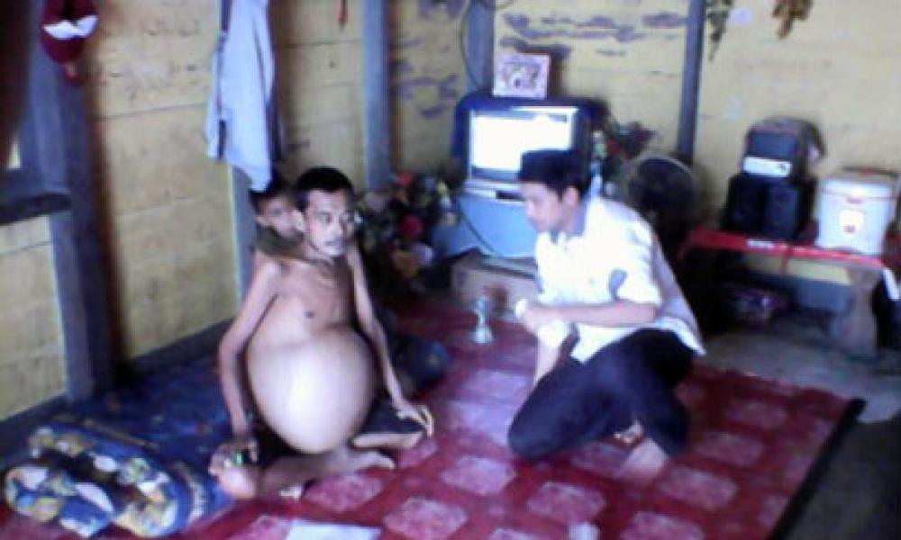 Warga Pangkalan Kerinci KTP Kampar Penderita Liver Alami Pembengkakan Perut