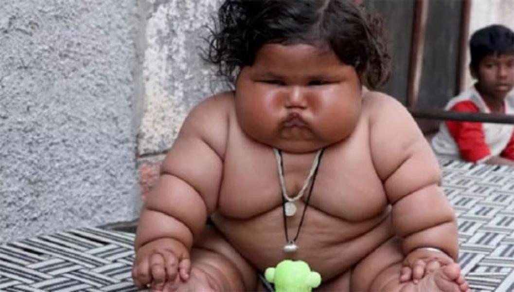 Bayi 8 Bulan Miliki Berat 17 Kg, Orangtua Tak Berdaya