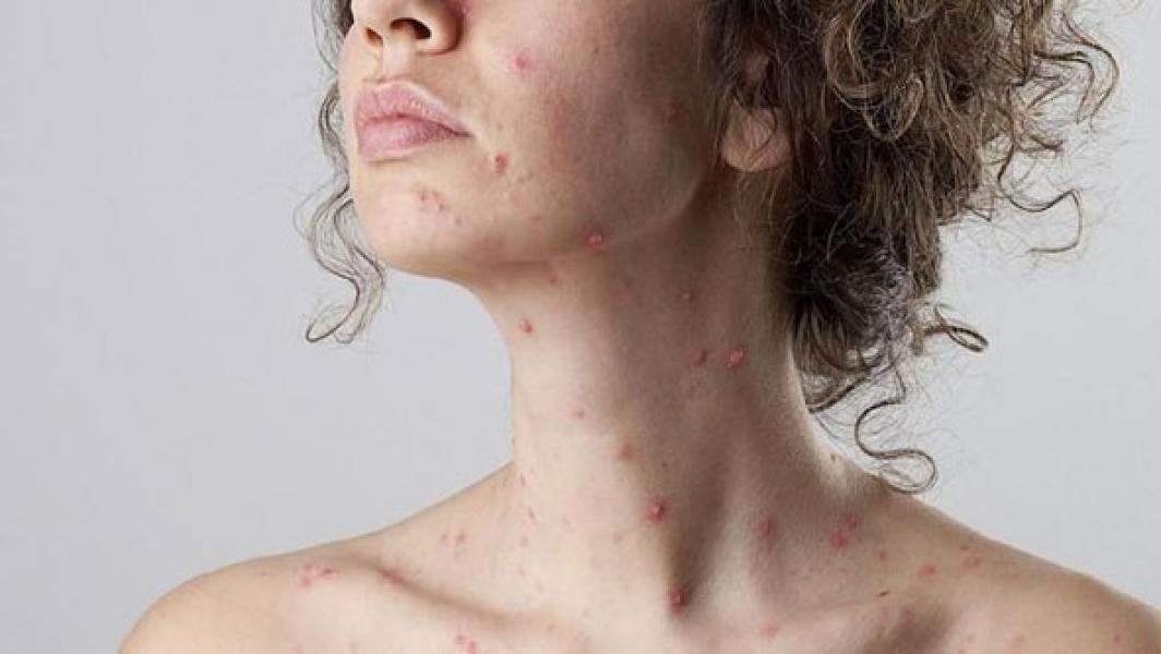 Batam Antisipasi Penularan Cacar Monyet dari Singapura