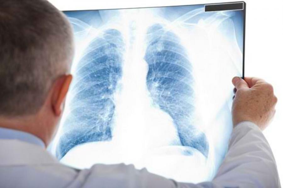 Mengenal Macam-Macam Pneumonia