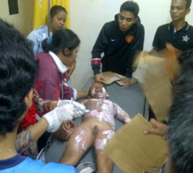 Listrik Padam, Bocah 10 tahun dan Ibunya Terbakar Lampu Minyak