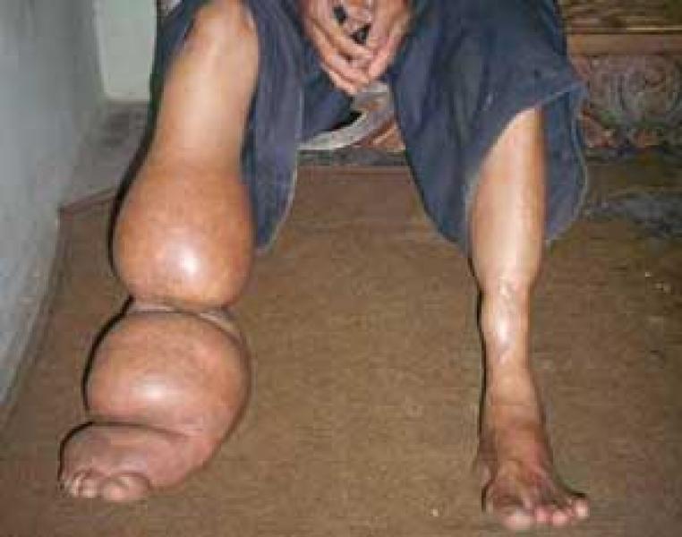 Warga Diminta Waspadai Penyakit Kaki Gajah  