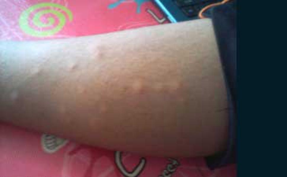 Warga Rantau Baru bawah Terserang  Gatal dan Penyakit Kulit