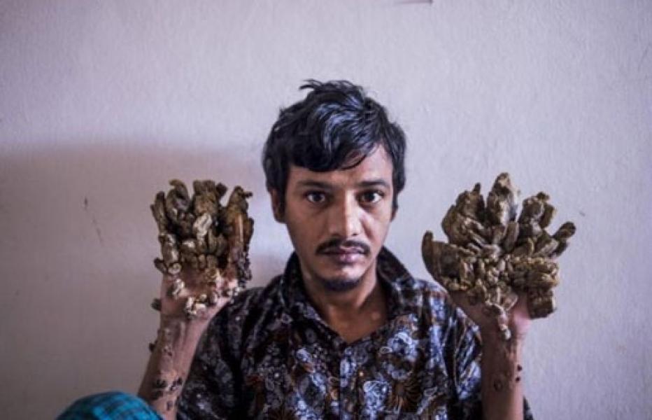 �Manusia Pohon� Bangladesh Ini Ingin Tangannya Diamputasi untuk Terbebas dari Sakit