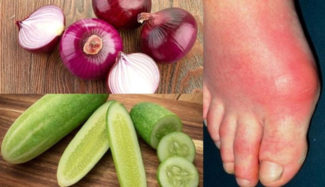 2 Bahan Dapur Ini Bisa Jadi Obat Asam Urat