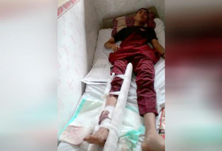 Tabrak Lari, Pelajar Alami Patah Tulang Kaki