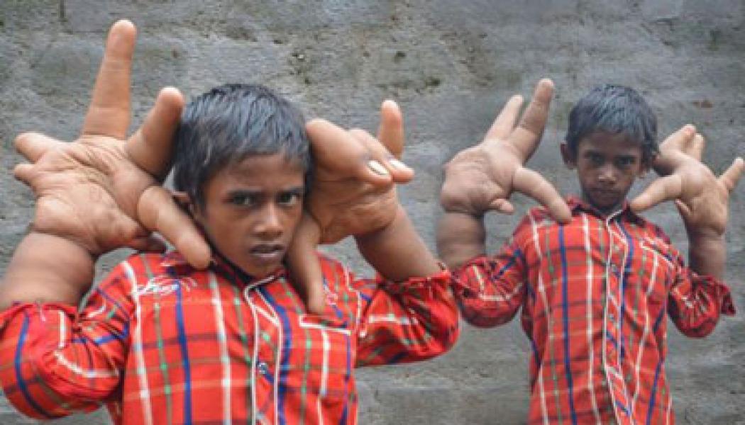 Bocah 8 Tahun di India Miliki Tangan Raksasa