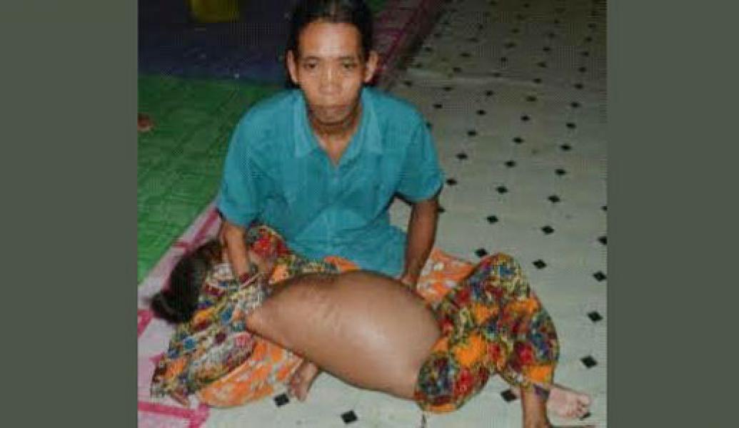 Alami Gizi Buruk, Dua Bocah Rohil Ini Butuh Uluran Tangan Dermawan