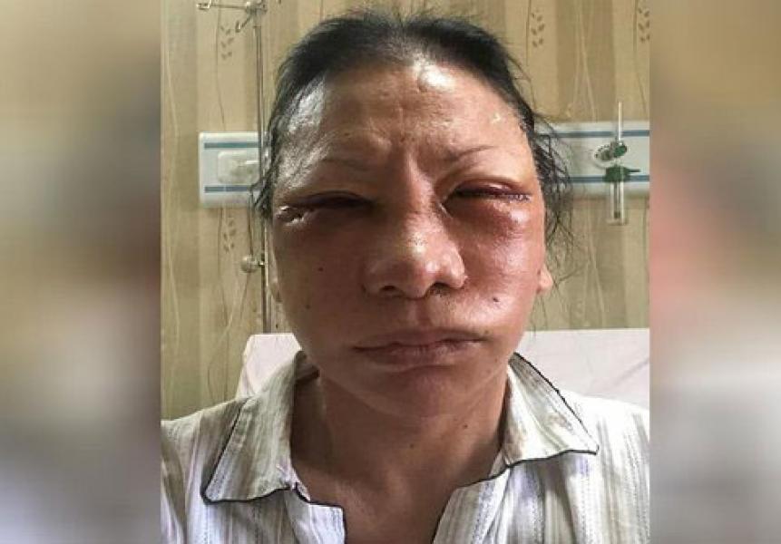 Beredar Foto Diduga Ratna Sarumpaet dengan Muka Babak Belur