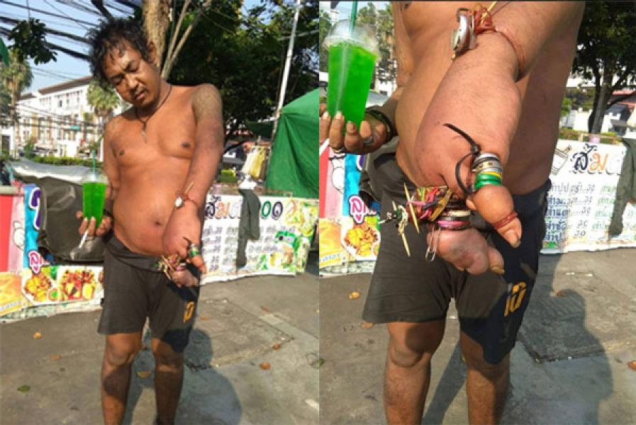 Terlalu Banyak Pakai Cincin, Jari Pria Ini Bengkak dan Membusuk