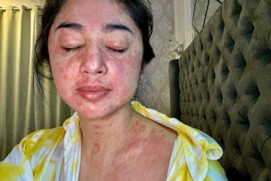 Dewi Perssik Mengalami Ruam karena COVID-19, Ini Penjelasannya!